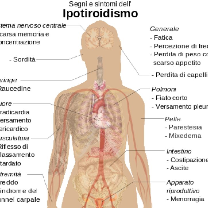 Ipotiroidismo