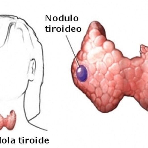 Nodulo-tiroideo