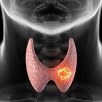 nodulo-tiroideo-2