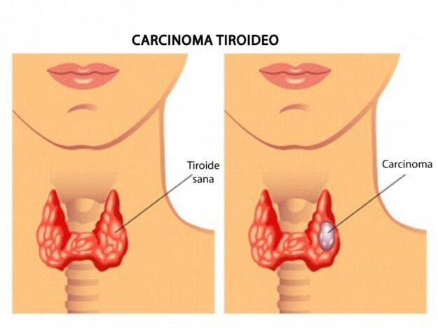 Carcinoma-tiroideo