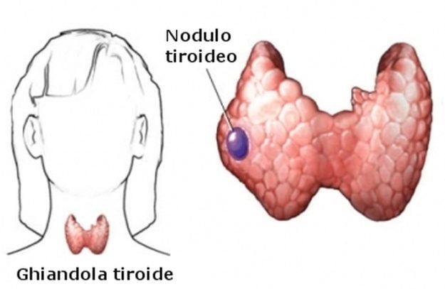 Nodulo-tiroideo