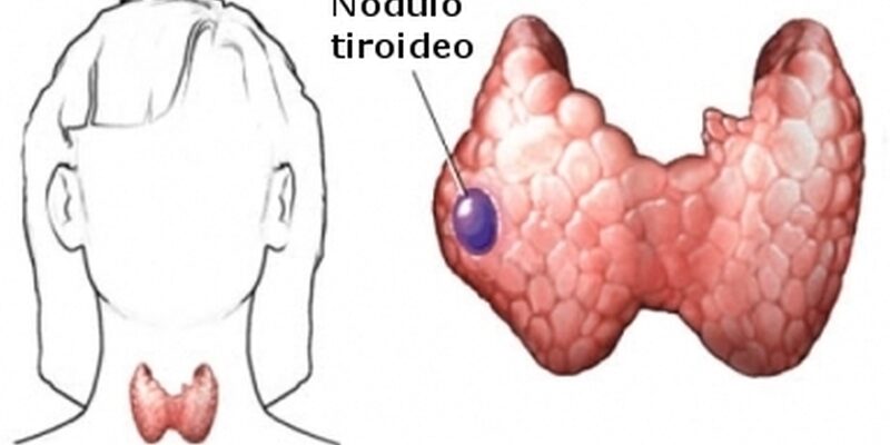 Nodulo-tiroideo