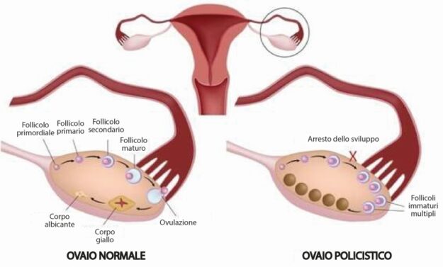 Ovaio-policistico