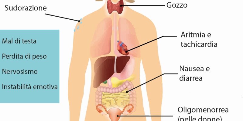 Sintomi-del-morbo-di-Basedow