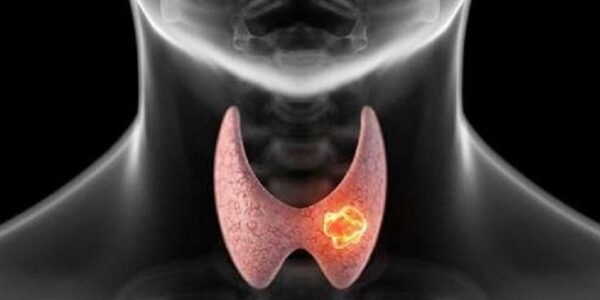 nodulo-tiroideo-2